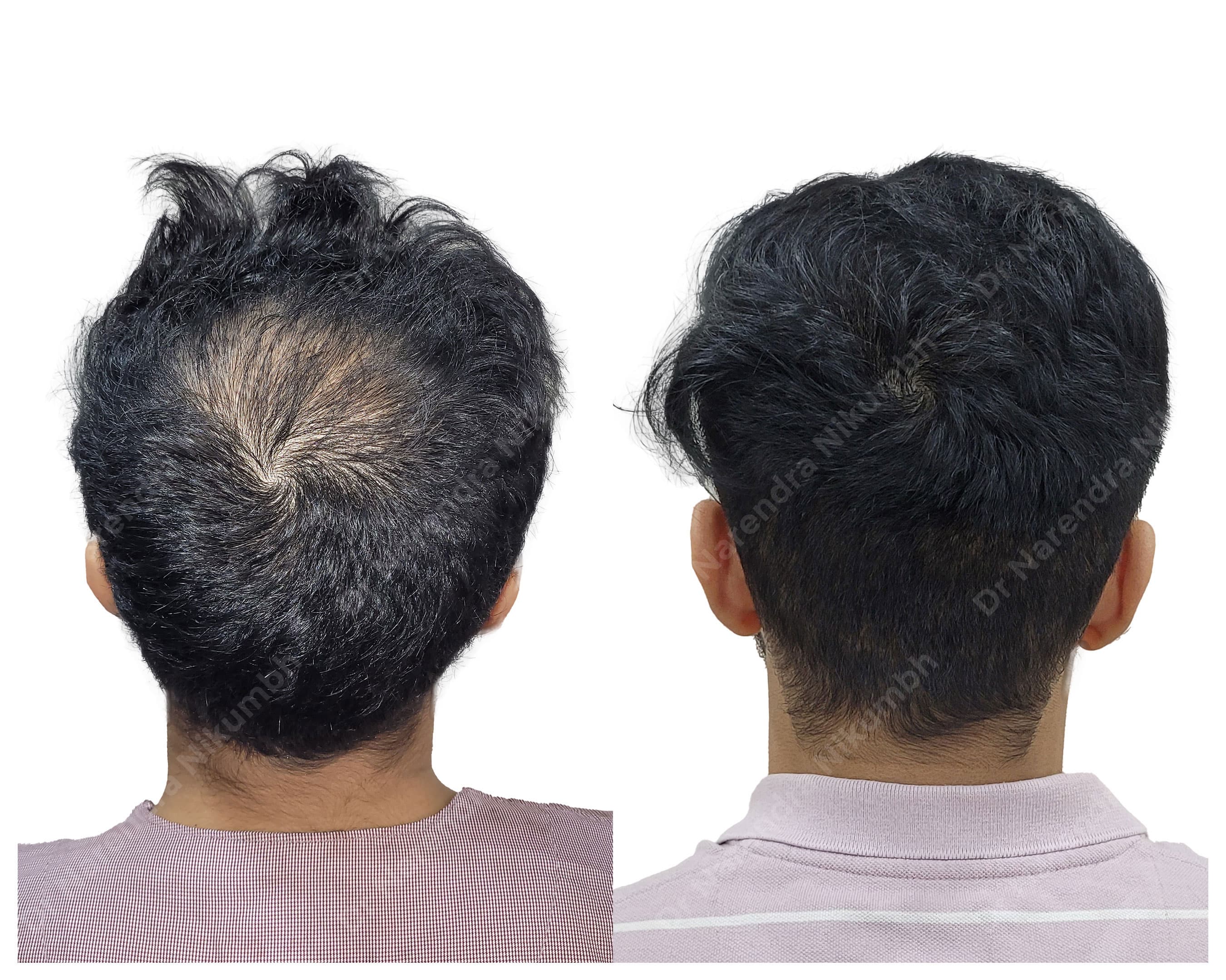 Hair restoration before and after result 1