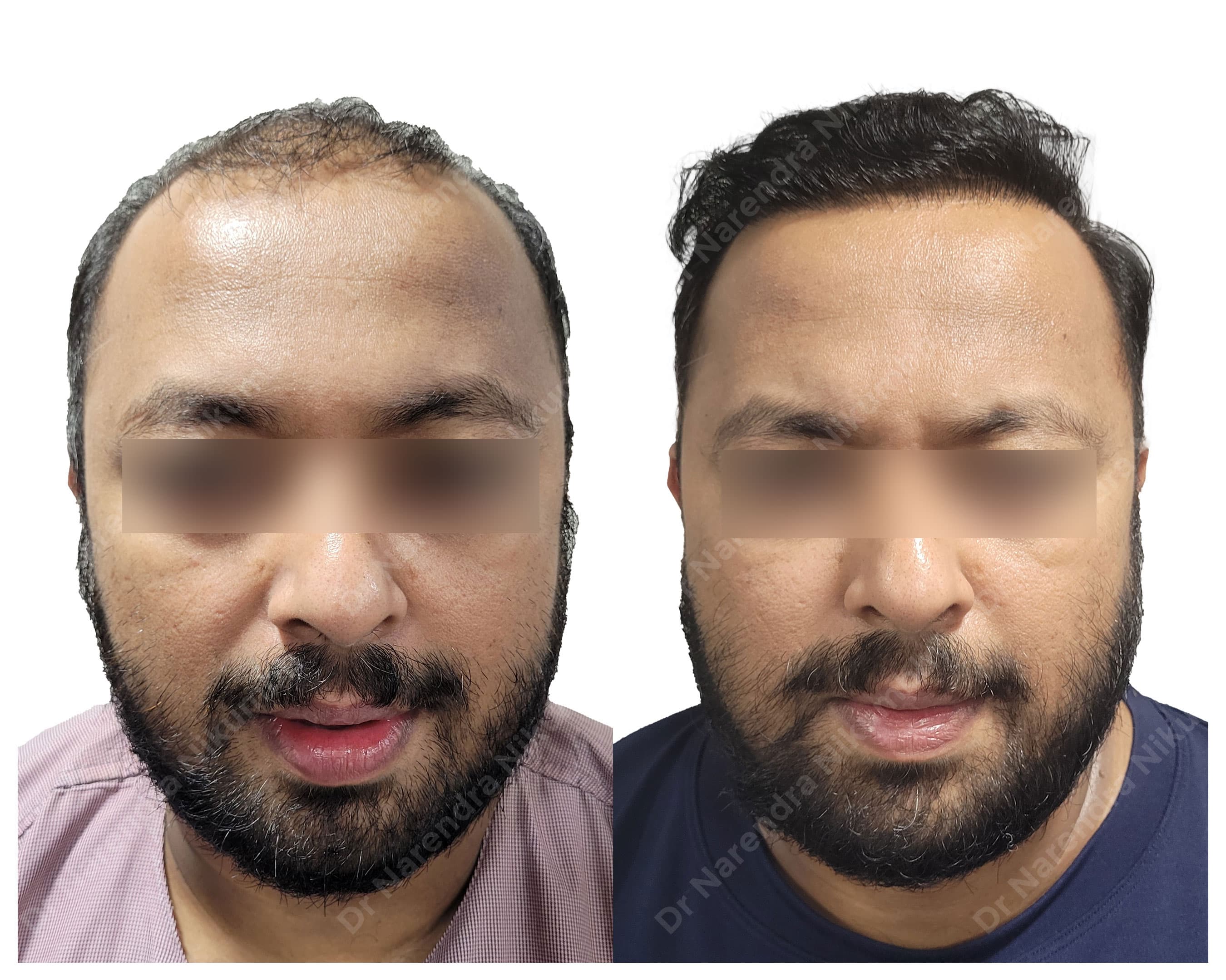 Hair restoration before and after result 2