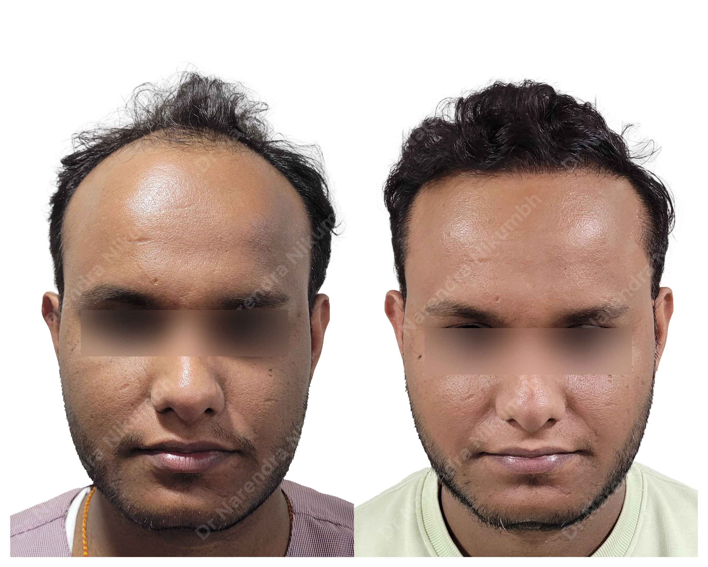 Hair restoration before and after result 3