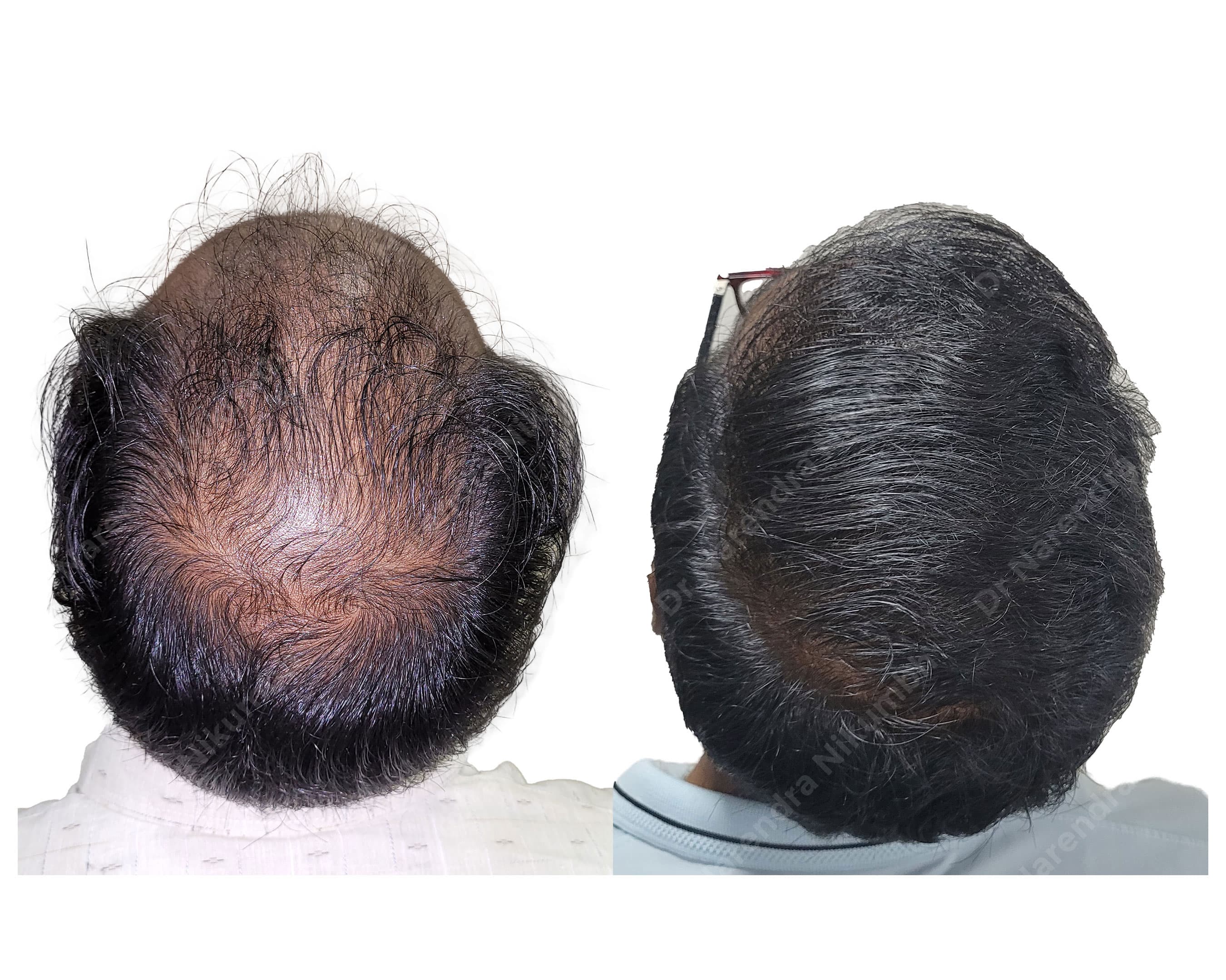 Hair restoration before and after result 4