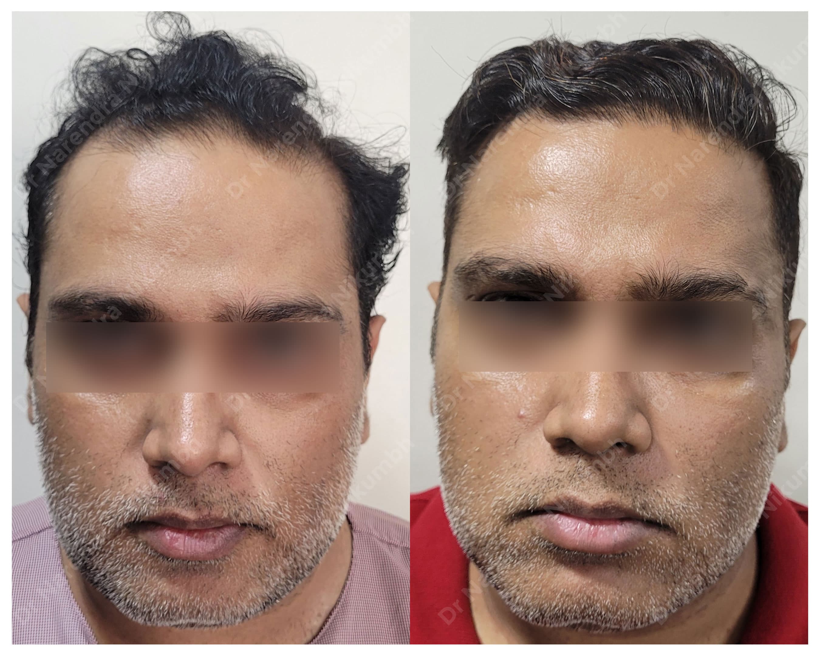 Hair restoration before and after result 5
