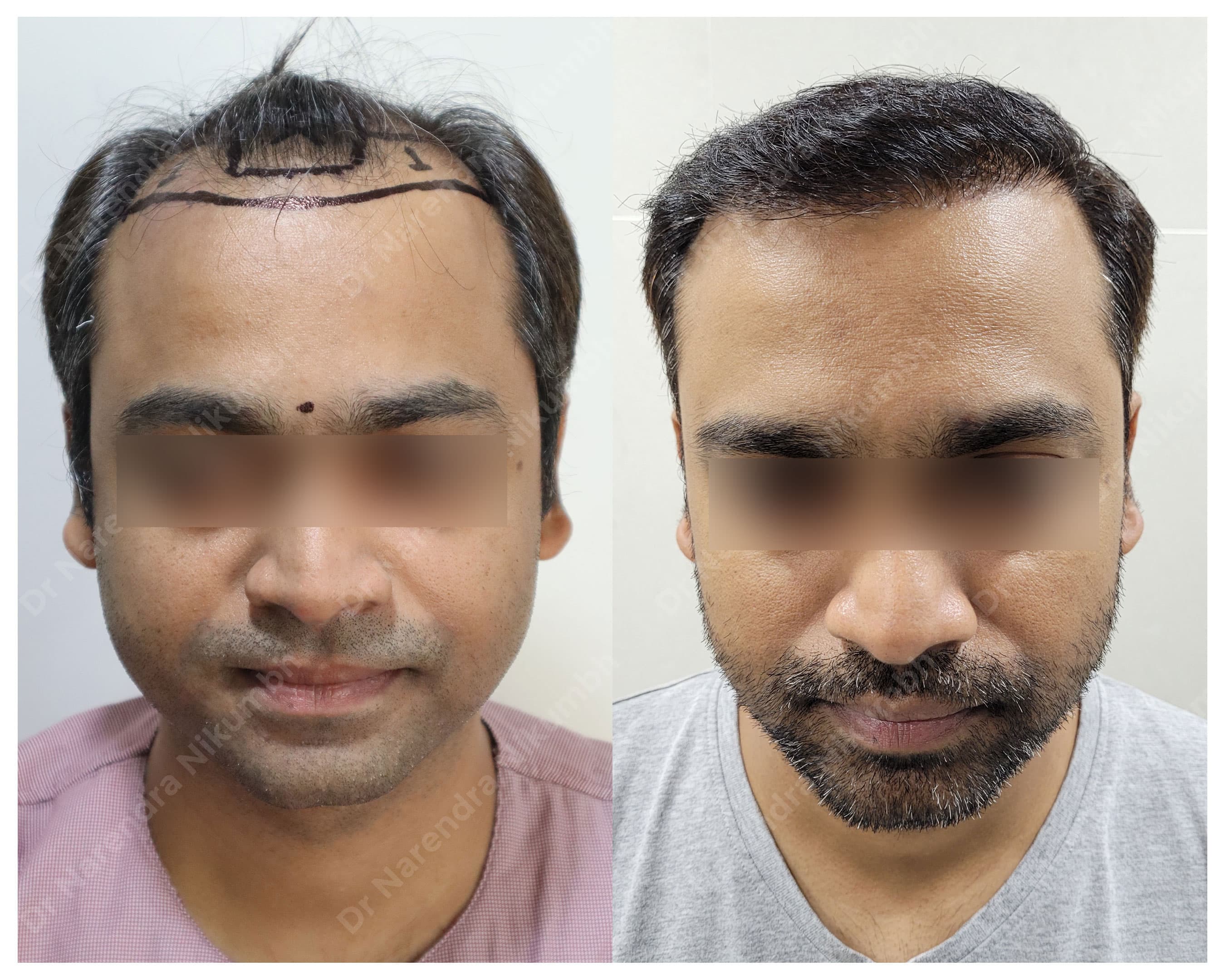 Hair restoration before and after result 6