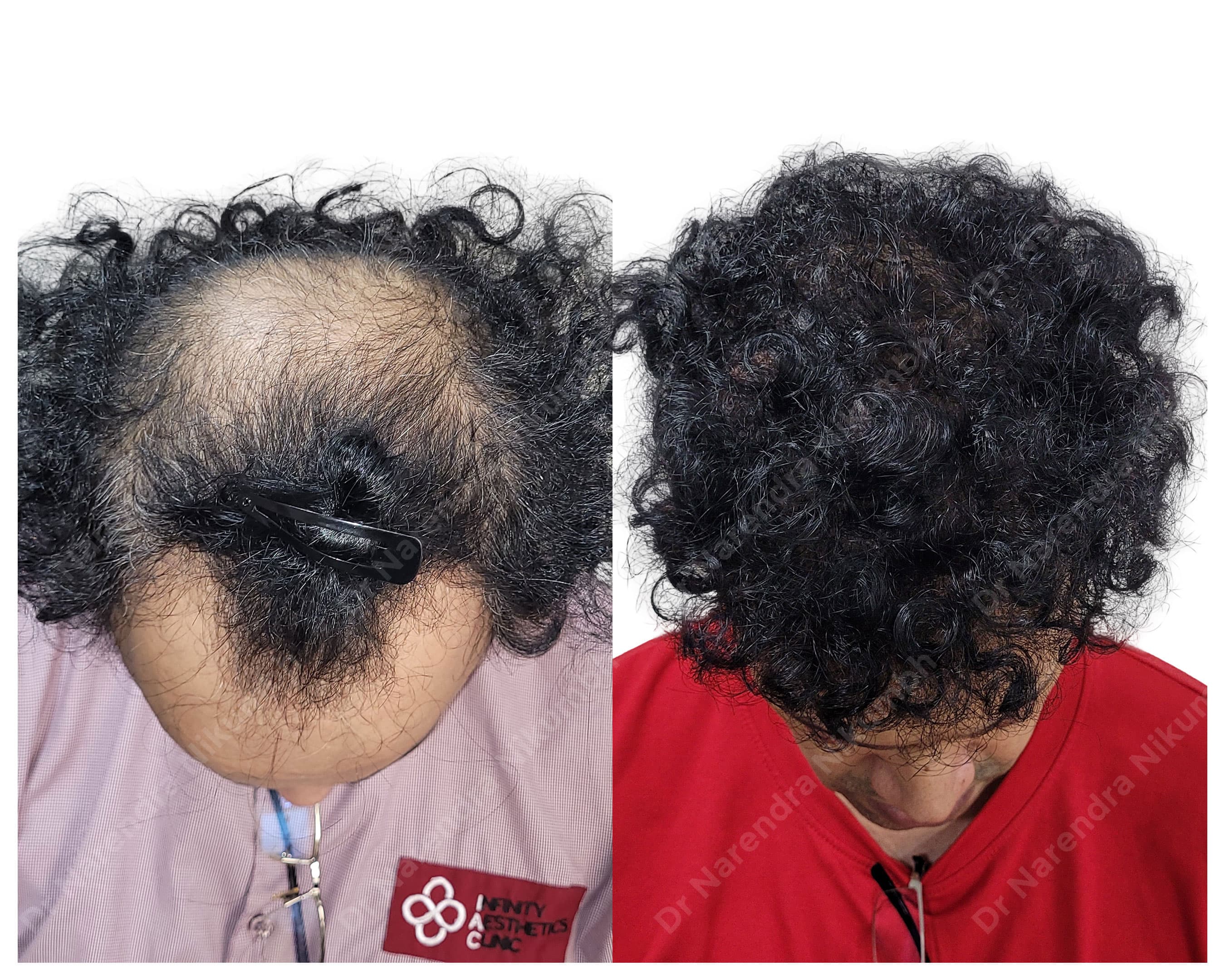 Hair restoration before and after result 7