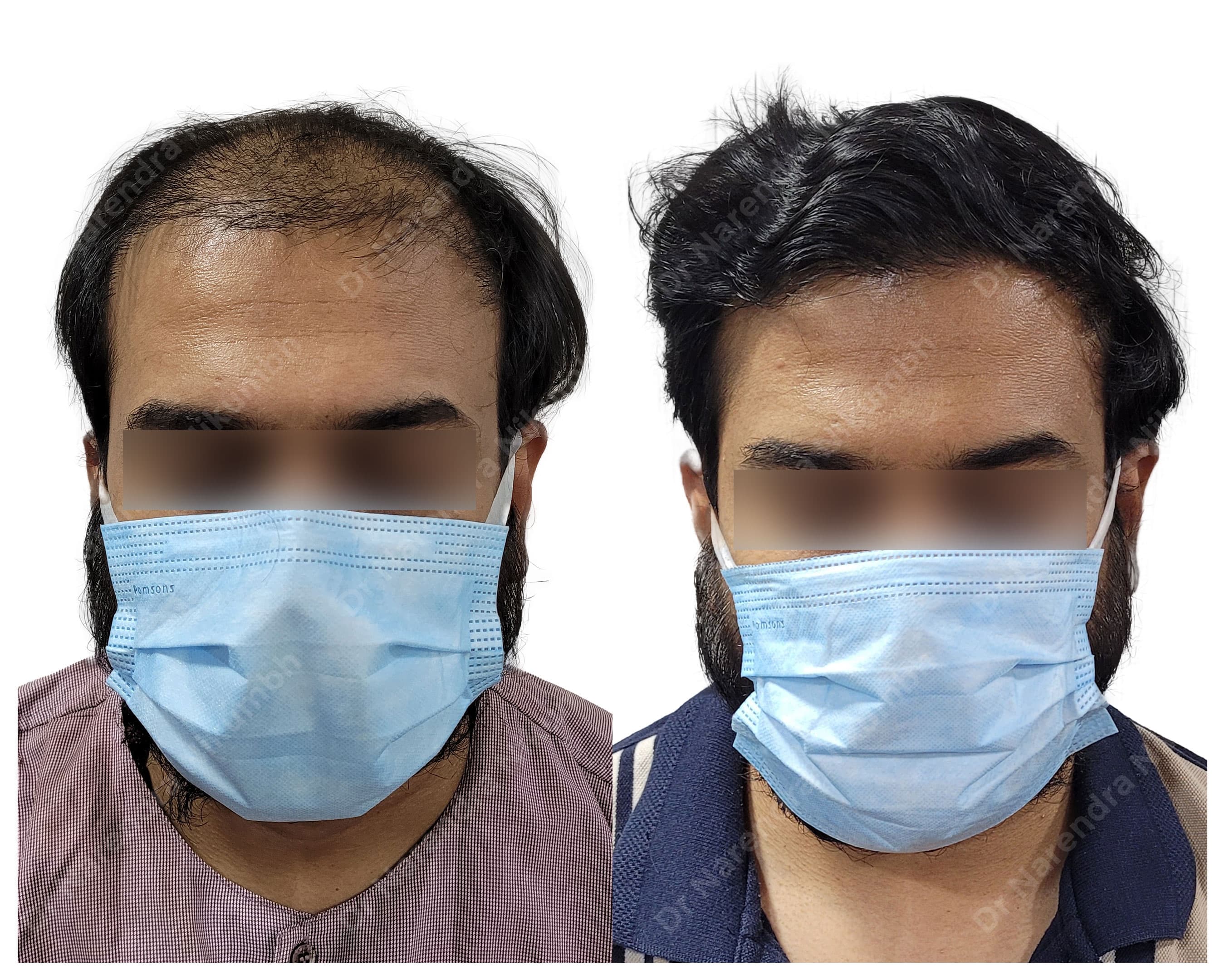 Hair restoration before and after result 8