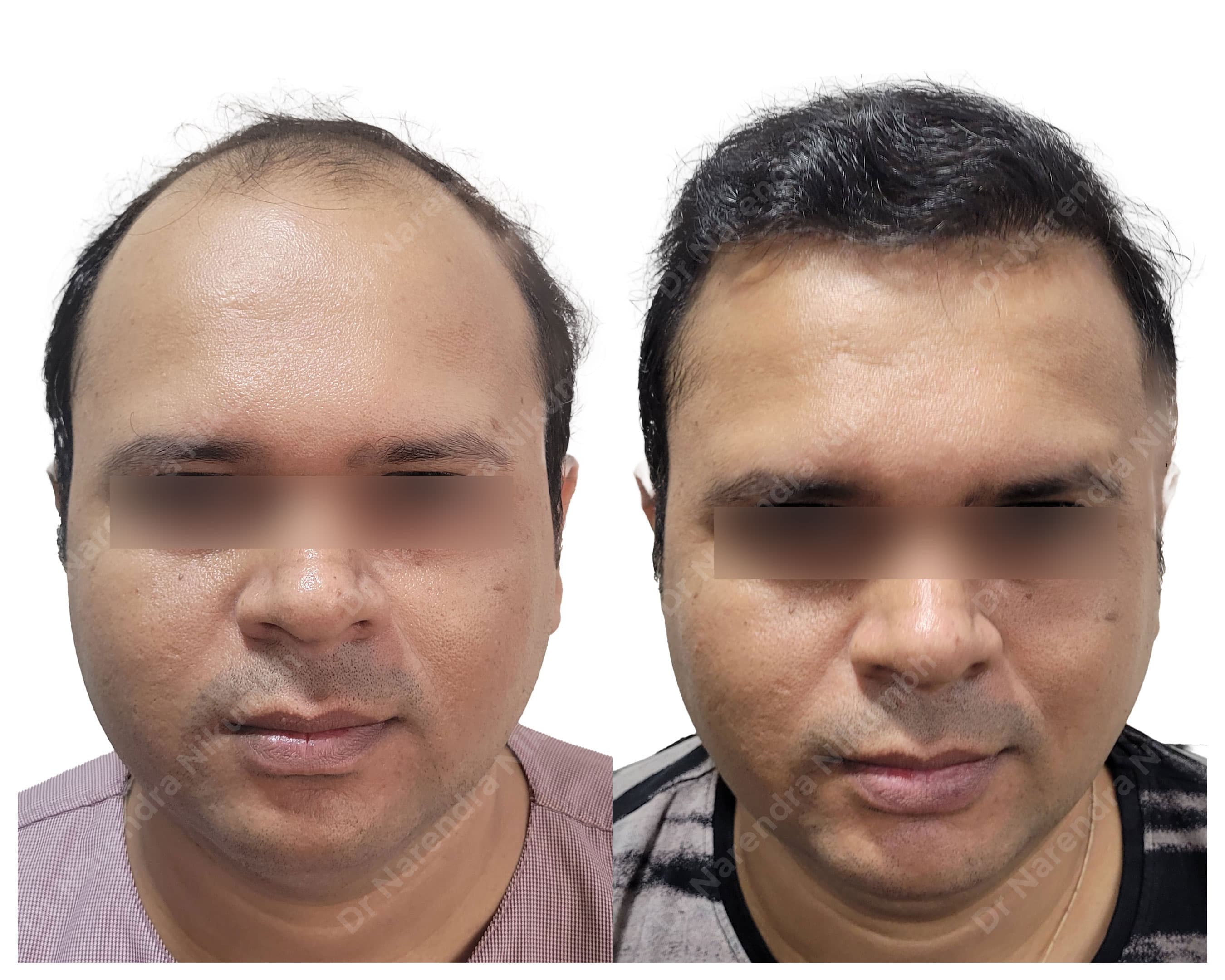 Hair restoration before and after result 9
